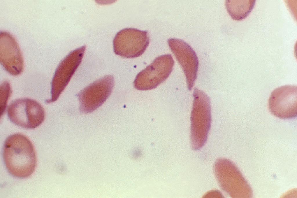 Crescent-shaped red blood cells from a sickle cell disease patient 