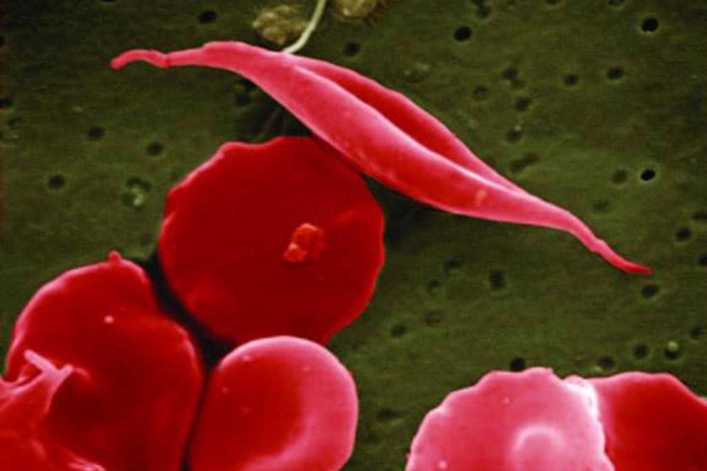 This electron microscope image provided by the National Institutes of Health in 2016 shows a blood cell altered by sickle cell disease